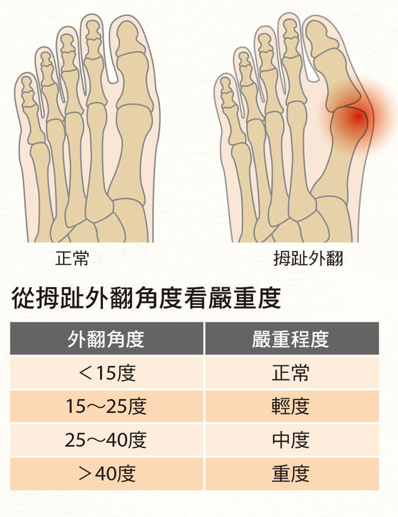 別怪高跟鞋 拇趾外翻是因遺傳和肌肉無力 康健雜誌