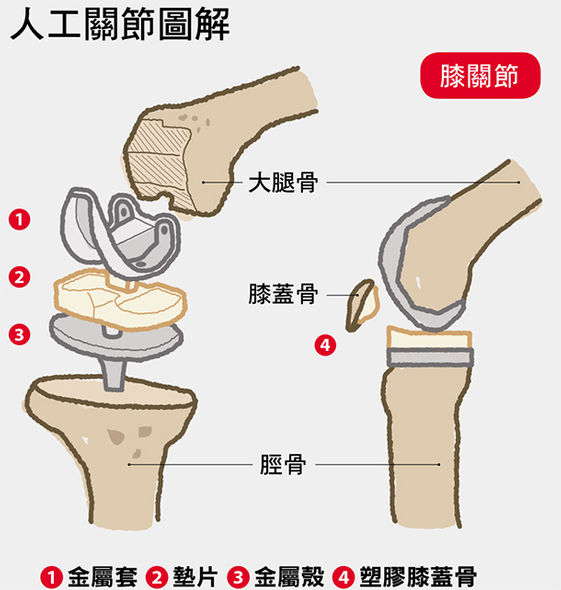 健保給付的醫材可信賴 換人工關節最想問的9件事 康健雜誌