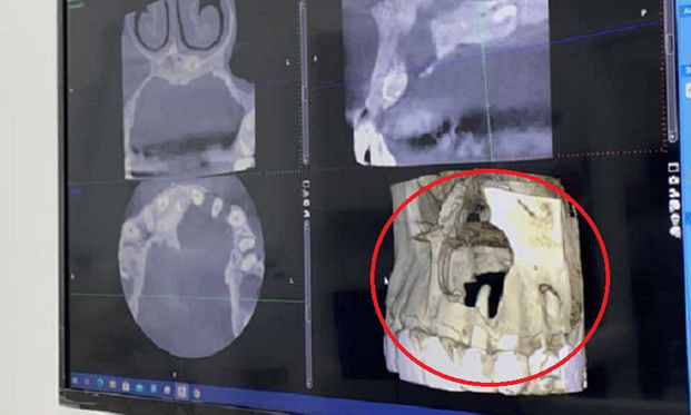 男星顎骨被侵蝕醫 放任蛀牙 牙周病 嚴重恐毀容 危及性命 康健雜誌