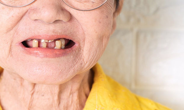 長輩缺牙 還會缺掉健康 更安全舒適的全口重建 消除長輩 植牙恐懼症 康健雜誌