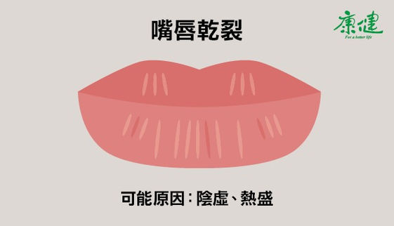 嘴唇發黑發紫是什麼狀況 6種唇色看健康 康健雜誌 嘴唇發黑發紫是什麼狀況 6種唇色看健康 康健雜誌