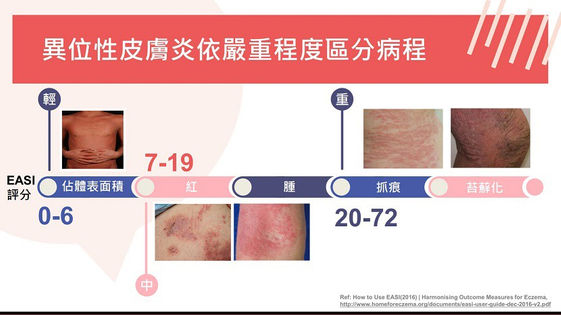 異位性皮膚炎無法根治控制差恐導致全身發炎 康健雜誌