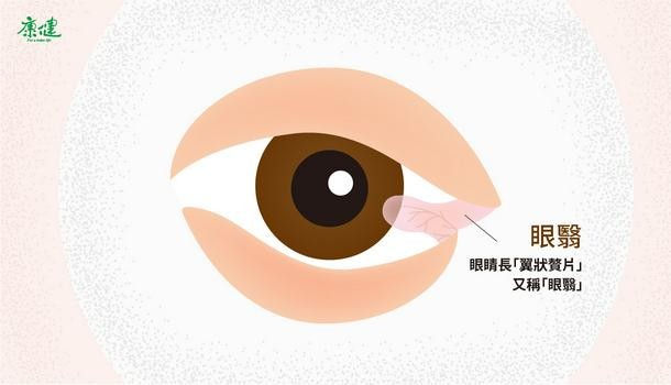 不只黃斑部病變眼睛不防曬小心 眼翳 找上門 康健雜誌 不只黃斑部病變眼睛不防曬小心 眼翳 找上門 康健雜誌