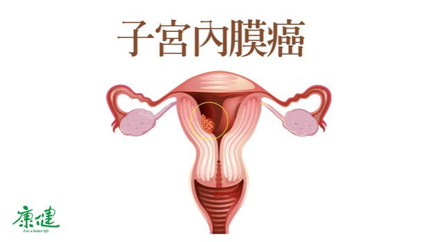 子宮內膜癌分期與存活率一張圖看懂 康健雜誌