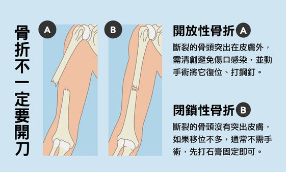 部 骨折 腿 大