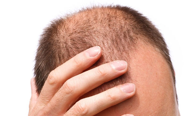 從雞皮疙瘩找到治療禿頭新方法醫師 活化毛囊幹細胞促生髮 康健雜誌