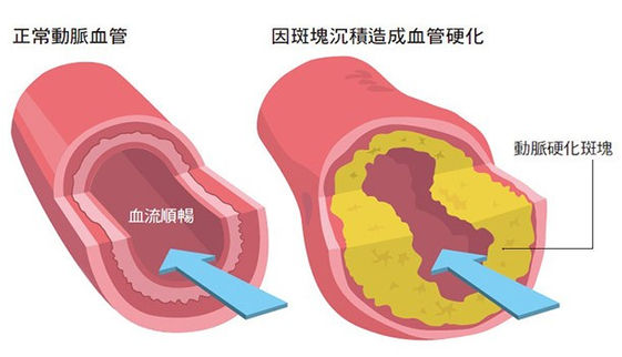 吃降血脂藥小心 搭配3種食物恐引發橫紋肌溶解等副作用 康健雜誌