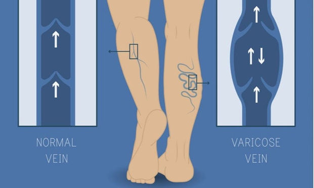 靜脈曲張嚴重可能致命6方式預防 康健雜誌