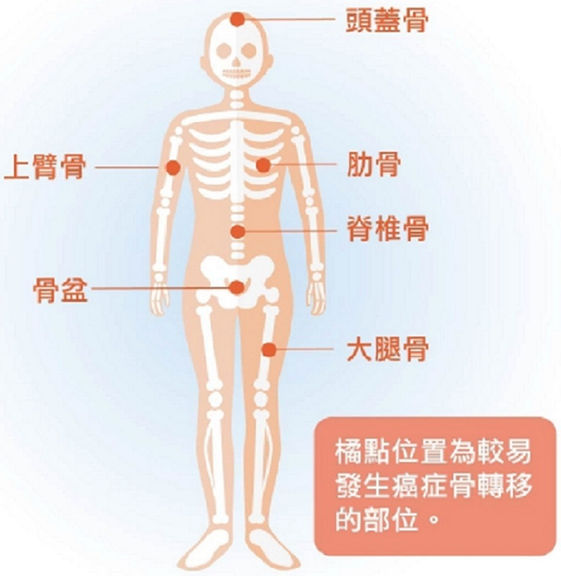 癌症骨轉移不可怕積極治療重拾生活品質 康健雜誌