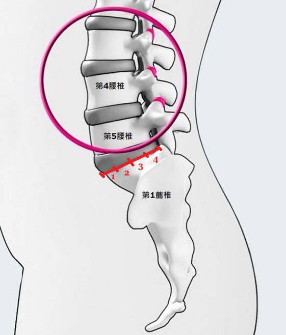 撐不住 的痛苦下背痛恐是脊椎滑脫症 康健雜誌