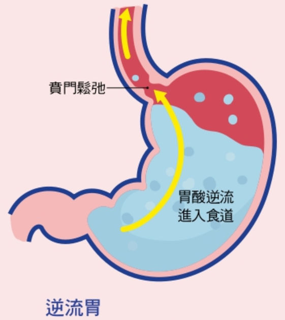 救救胃食道逆流全方位保胃戰 康健雜誌