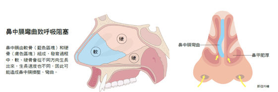 鼻中隔偏曲 就要手术 医生 得先了解这些问题 腾讯新闻
