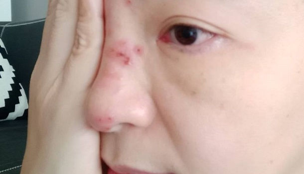 女主播跑了5趟醫院才知染 帶狀皰疹 初期很難確診 康健雜誌 女主播跑了5趟醫院才知染 帶狀皰疹 初期很難確診 康健雜誌