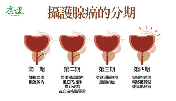 攝護腺癌如何分期 存活率多少 治療有不同方式 康健雜誌