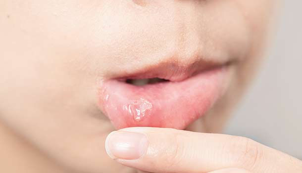 嘴破 嘴巴潰瘍有2種嘴破多久沒好可能是口腔癌 康健雜誌