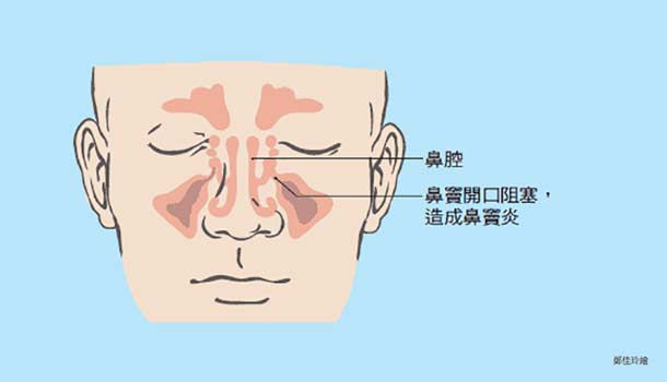 不自覺愛挖鼻孔當心慢性鼻竇炎作祟 康健雜誌