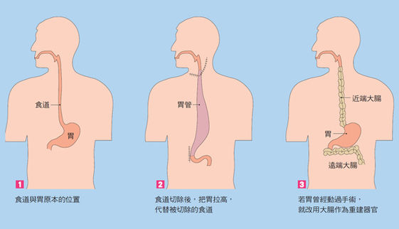 食道癌為什麼難治 康健雜誌