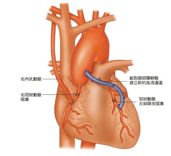 美國前總統柯林頓 日本明仁上皇為什麼不放心臟支架 而要做繞道手術 康健雜誌