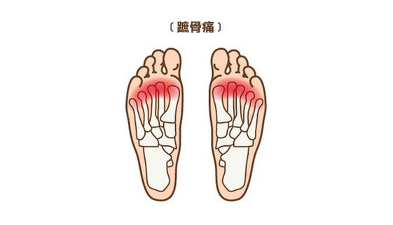 腳痛不一定是足底筋膜炎 蹠骨痛等5大足病要注意 康健雜誌