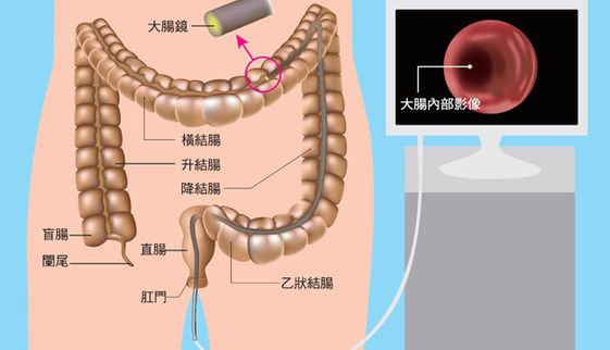 該做哪種大腸鏡檢查 康健雜誌