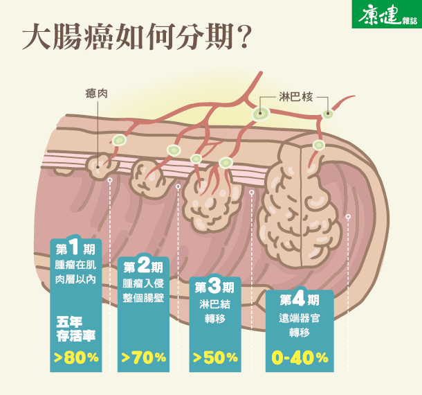 豬哥亮癌逝享壽70歲大腸癌分期不可不慎！ - 康健雜誌