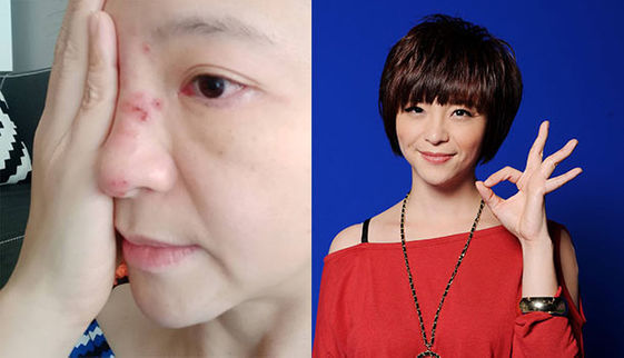 女主播跑了5趟醫院才知染 帶狀皰疹 初期很難確診 康健雜誌 女主播跑了5趟醫院才知染 帶狀皰疹 初期很難確診 康健雜誌