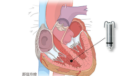 裝了心律調節器生活更美好 康健雜誌