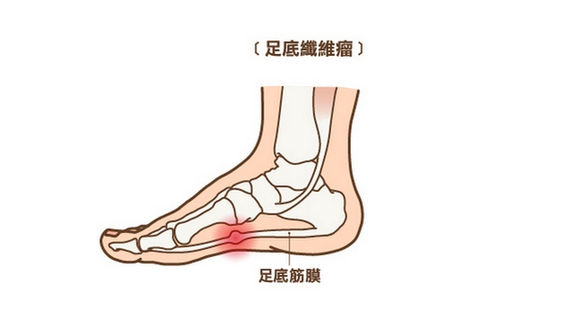 腳痛不一定是足底筋膜炎 蹠骨痛等5大足病要注意 康健雜誌