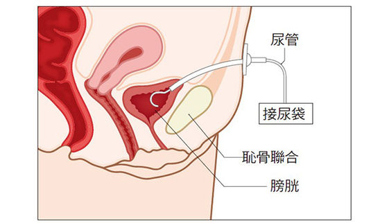 協助長輩脫離導尿管 有方法 康健雜誌