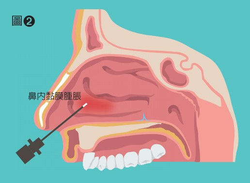 鼻過敏新手術截斷神經該不該做 康健雜誌